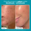 Paula’s Choice 2% BHA Liquid Exfoliant