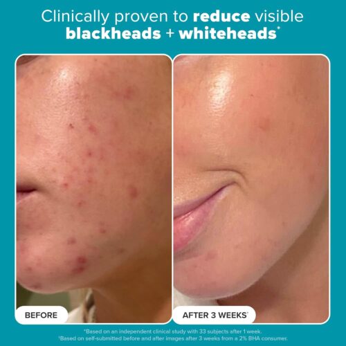 Paula’s Choice 2% BHA Liquid Exfoliant